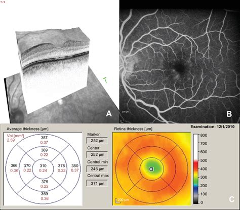 Figure 2 From Spectral Domain Optical Coherence Tomography Documented Rapid Resolution Of