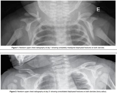 Shoulder Dystocia WikEM