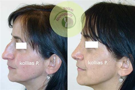 Rhinoplasty Nasal Tip Ptosis 027 Π Κόλλιας