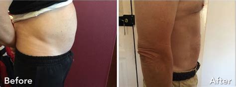 Cryolipolysis | 2023 Nonsurgical Fat Reduction CoolSculpting