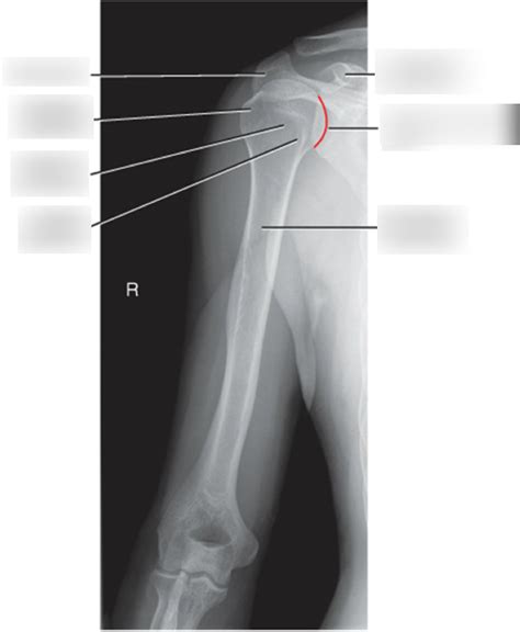 DIAGRAM - AP Humerus Anatomy(Xray) -2018 Diagram | Quizlet