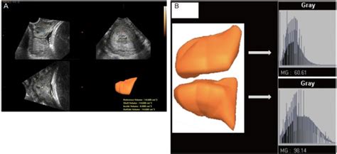 Three Dimensional Ultrasound Cervical Volume Measurement A