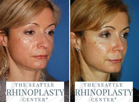 Excess Columellar Show Before and After Photo Gallery - Nose Surgery Photos