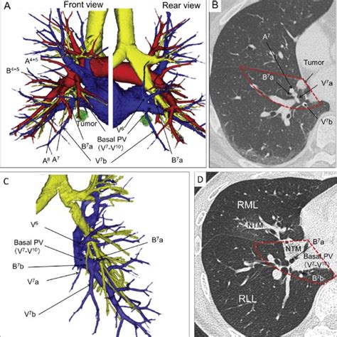 A C Three Dimensional Computed Tomography Angiography And