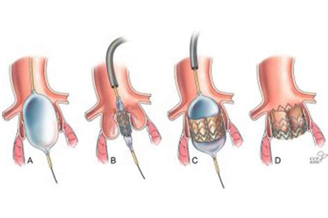 TAVI Chirurgische Transkatheter Aortenklappen Implantation Herz Und