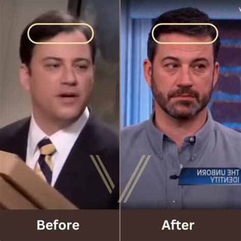 Jimmy Kimmel Hair Transplant