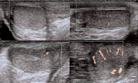 Figure From Comparison Of The Superb Microvascular Imaging Technique