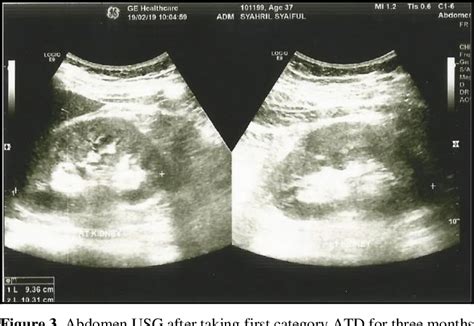 Figure From Appendicular Tuberculosis As Manifestation Of