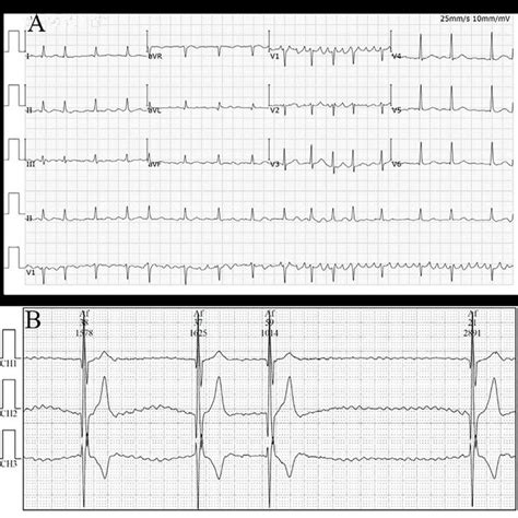 Electrocardiogram Of Case 2 Picture A Showed Atrial Fibrillation