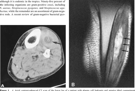 Figure 1 From Pyomyositis Of The Anterior Tibial Compartment