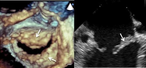 Advanced Echocardiography For The Diagnosis And Management Of Infective Endocarditis Intechopen