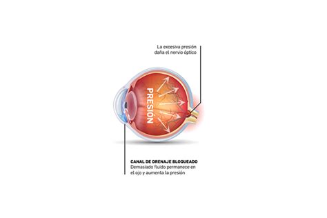 Farmacéuticos Promueven La Prevención Precoz Del Glaucoma Im Farmacias