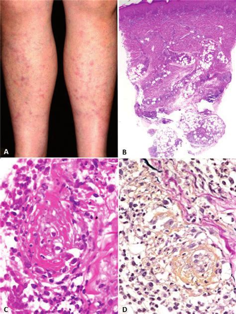 Clinicopathological Features Of An Erythema Nodosum Like Lesion Of The Download Scientific