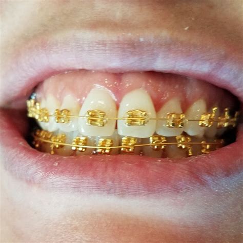 Gold Braces Las Vegas Nevada Dentistry And Braces