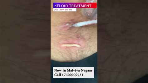 Best Keloid Injection Treatment Viral Shorts YouTube