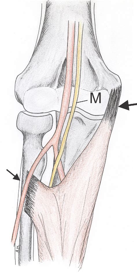 Figure 34 From Ultrasound Of The Elbow With Emphasis On Detailed