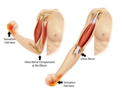 Cubital Tunnel Syndrome | STAR Physical Therapy | Tennessee | TN