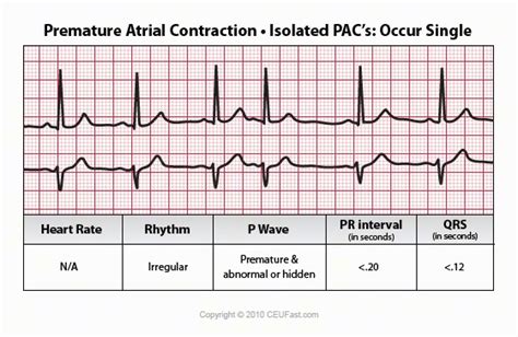 Premature Atrial Contraction Ecg Interpretation Continuing Education