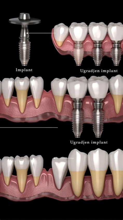 Zubni Implanti Dental Dr Miodrag Djokic