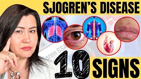 10 Signs of Sjogren’s Syndrome | Patient Talk