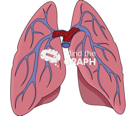 Saddle Pulmonary Embolism Front View