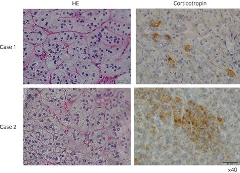 Intraadrenal Corticotropin In Bilateral Macronodular Adrenal