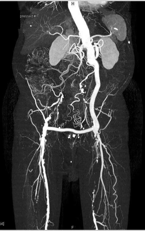 Fem Fem Bypass Graft With Left Superficial Femoral Artery Sfa