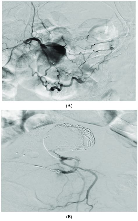 A Initial Angiogram Demonstrated A Large Psa Arising From The Left