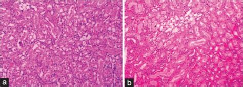 (a) Pathological changes (parenchymal damage) in contralateral kidney... | Download Scientific ...