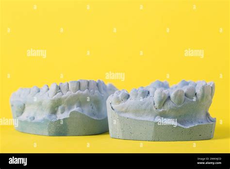 Blue Plaster Impression Of A Patient S Dental Jaw With Crooked Teeth