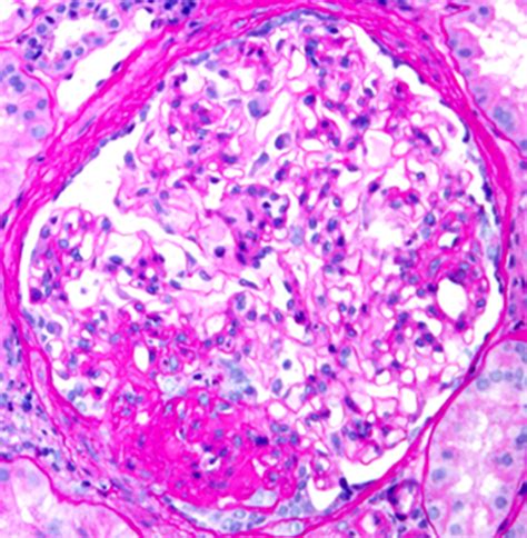 Pathology Outlines Focal Segmental 58 Off