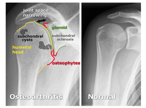 Subchondral Degenerative Cysts Subchondral Bone Cysts Comprehensive