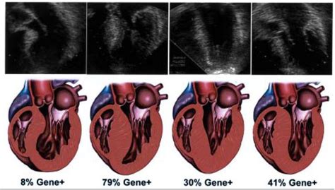 hypertrophic cardiomyopathy - Google Search | Hypertrophic ...