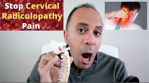 Stop Cervical Radiculopathy Naturally Symptoms Causes Risk Factories