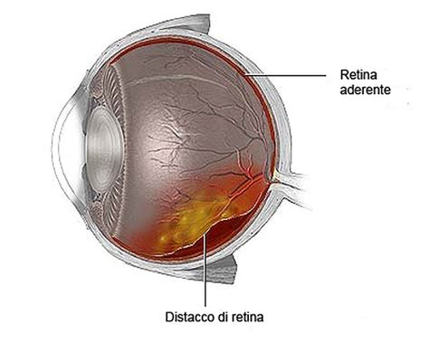 Distacco Della Retina Salus Ottica