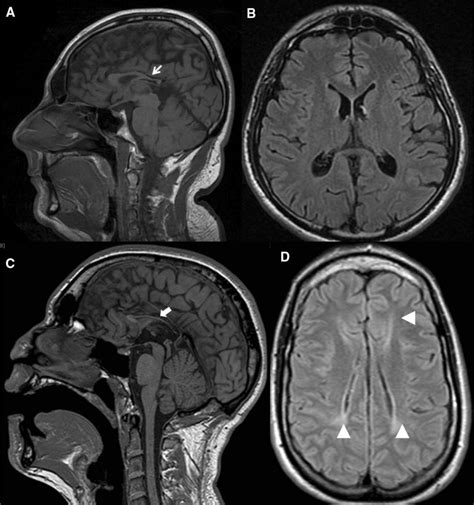 Ad Brain MRI Sagittal T1 Weighted A C And Axial FLAIR Sections B