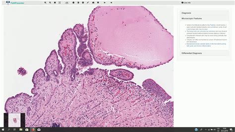 Nephrogenic Adenoma Histopathology Youtube