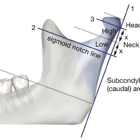 Classification Of Condylar Fractures According To The Ao Cmf Trauma Download Scientific Diagram