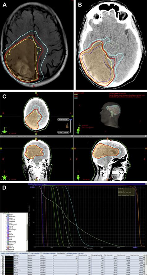 Principles And Tenets Of Radiation Treatment In Glioblastoma Neupsy Key