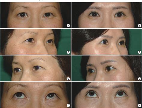 Lateral Canthoplasty