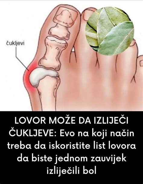 LOVOR MOŽE DA IZLIJEČI ČUKLJEVE Evo na koji način treba da iskoristite