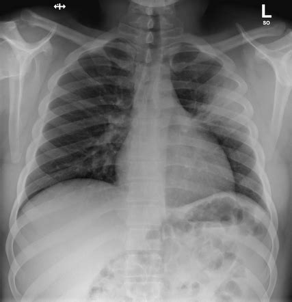 Left Upper Lobe Consolidation Radiology Case Radiopaedia Org