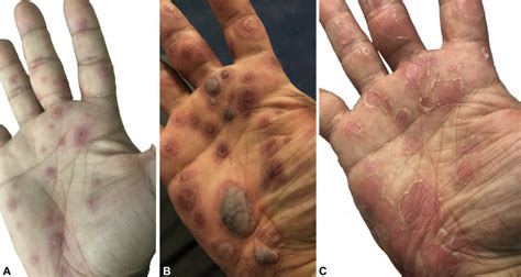 Erythema Multiforme Minor Hand