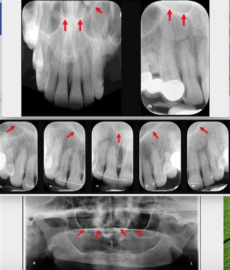 Floor Of Nasal Fossa Diagram Quizlet