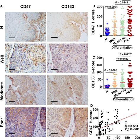 Association Between Cd47 And Cd133 Expression Levels And Tumor