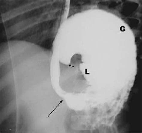 Mesenteroaxial Volvulus Patient 1 Single View From A Ugi Series Download Scientific Diagram