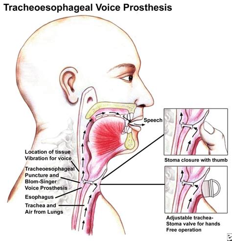 Laryngectomy Rehabilitation Overview Evaluating Tracheoesophageal Speech Tracheoesophageal