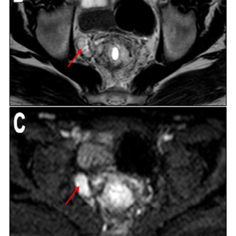 Mri For A Year Old Male Patient With Pathologically Proven Rectal