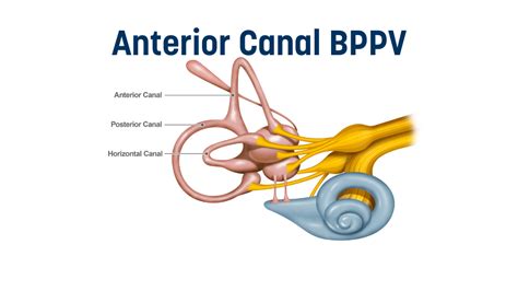 Anterior Canal BPPV - Vestibular First