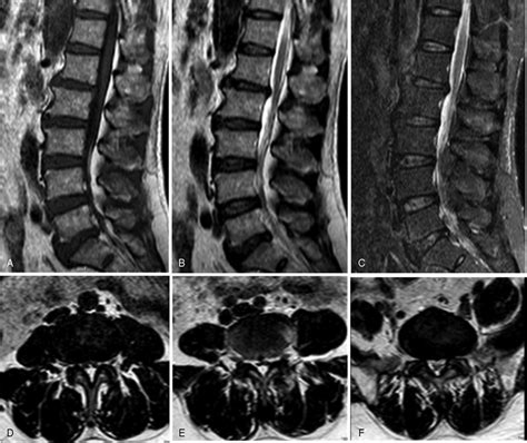 Lumbar Mri Showed That The Adipose Tissue Compresses The Thecal Sac At